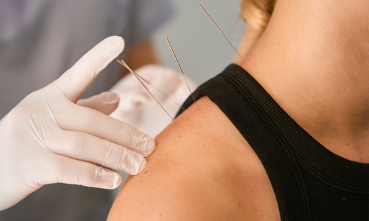 Acupunctuurbehandeling (60 min)