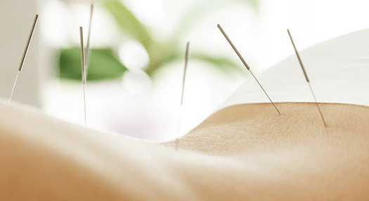 Afslappende akupunktur & cupping